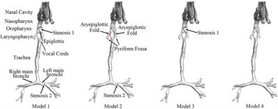 Aerodynamic evaluation of surgical design for the stenosis correction of airway